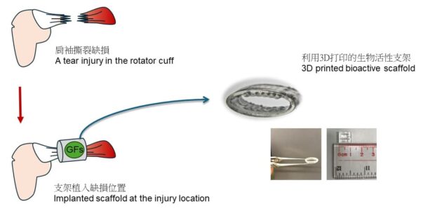 香港中文大学开发了一种可植入的3D打印弹性体助力肩袖恢复